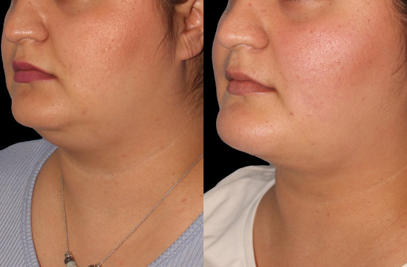 Patient 39 Combined Image