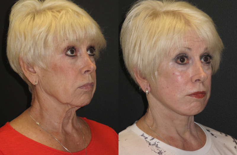 Patient 51 Combined Image