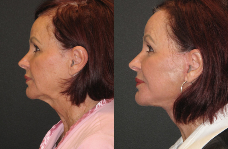 Patient 54 Combined Image