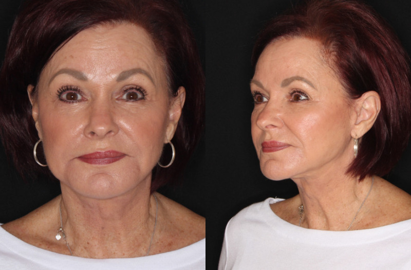 Patient 54 Combined Image