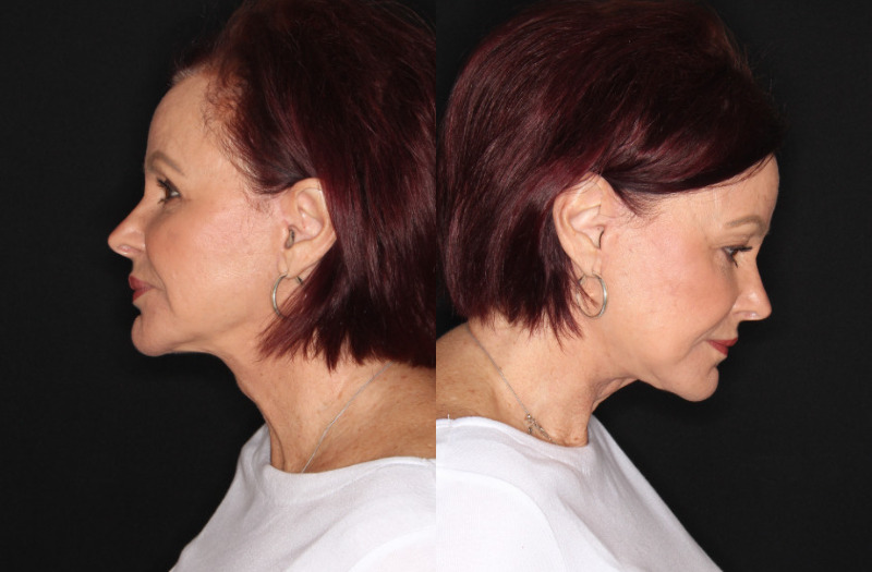 Patient 54 Combined Image