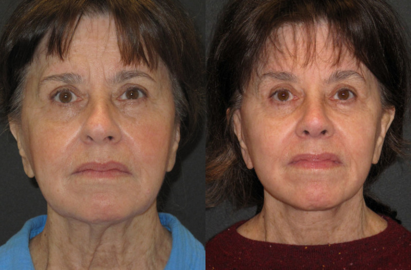 Patient 56 Combined Image