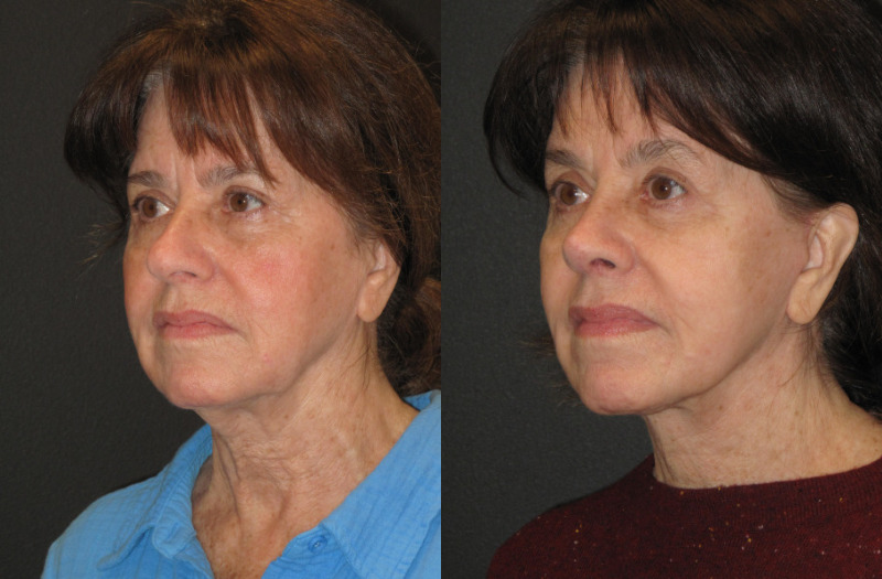 Patient 56 Combined Image