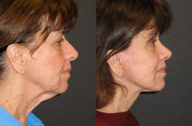 Patient 56 Combined Image