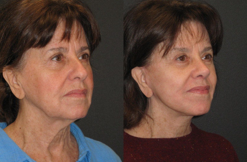 Patient 56 Combined Image