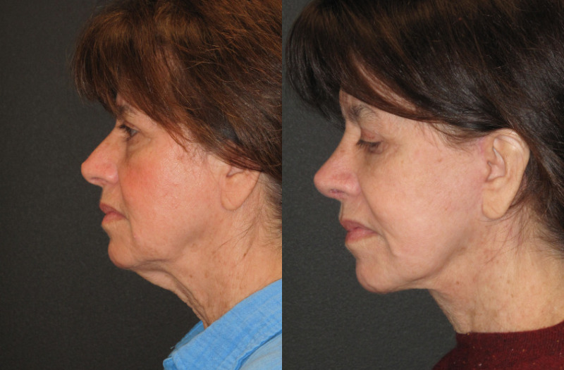 Patient 56 Combined Image