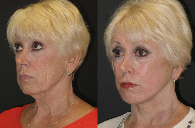 Patient 51 Combined Image