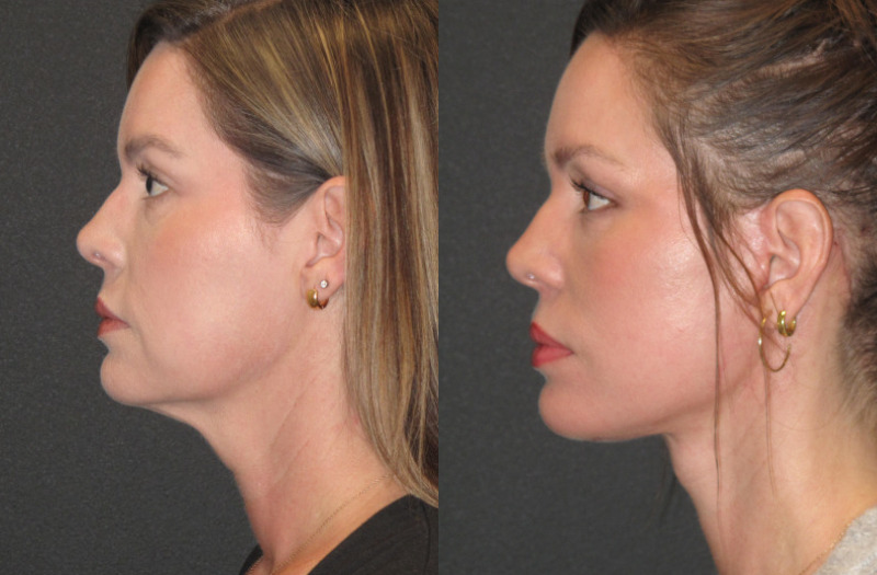 Patient #57 Combined Image