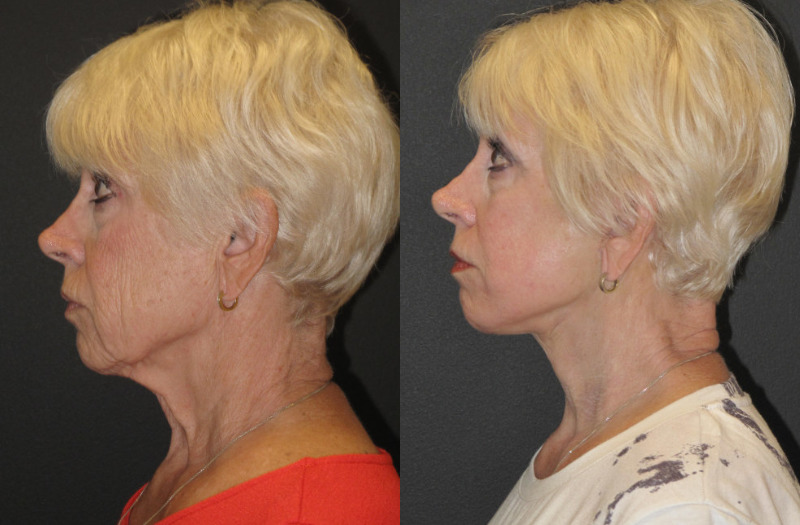 Patient 51 Combined Image