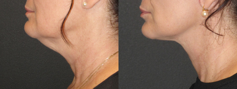 Patient 54 Combined Image