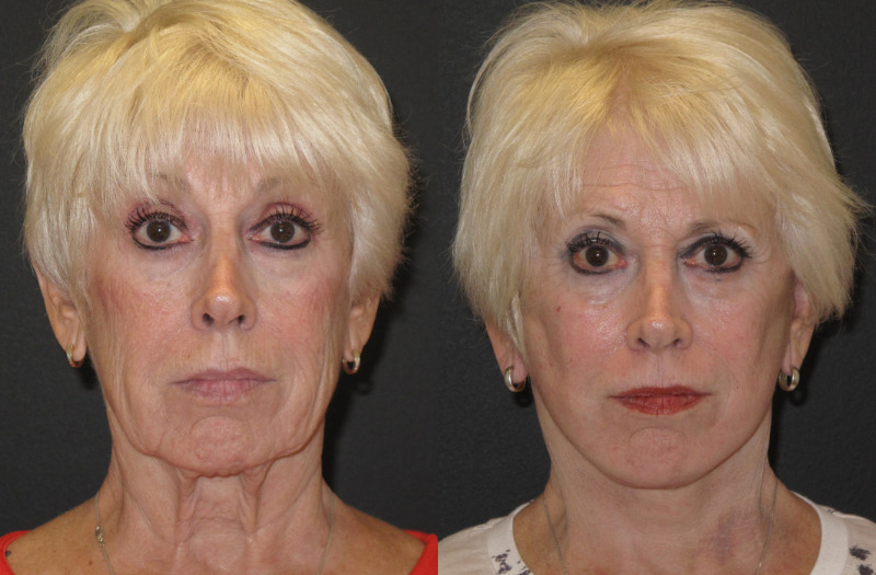 Patient 51 Combined Image