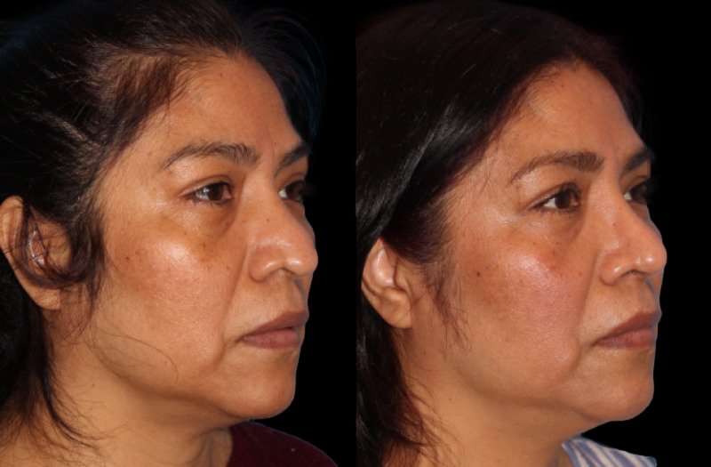 Patient 11 Combined Image