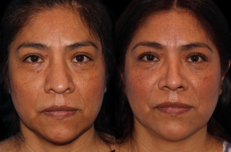 Patient 11 Combined Image