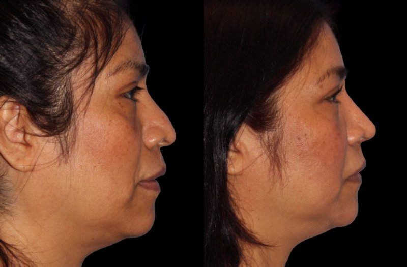 Patient 11 Combined Image