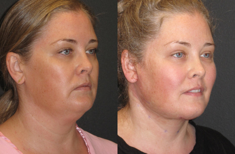 Patient 52 Combined Image