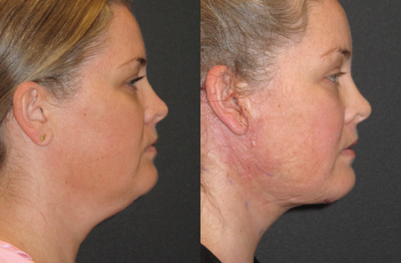 Patient 52 Combined Image