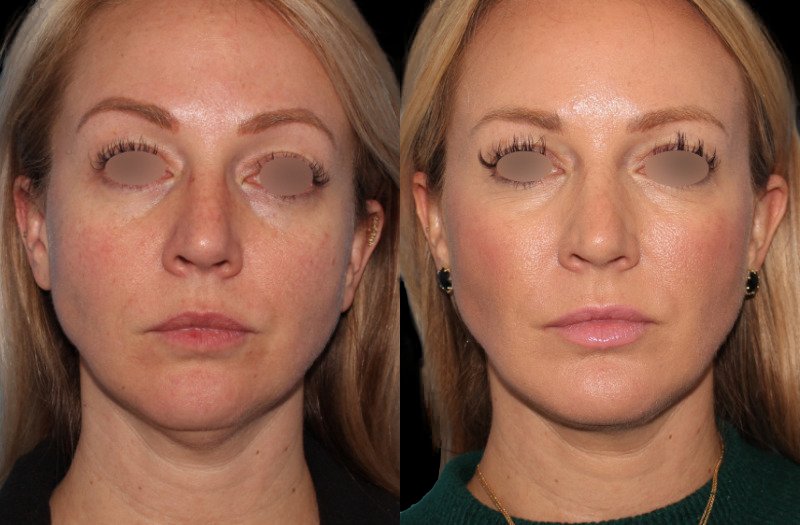 Patient 31 Combined Image