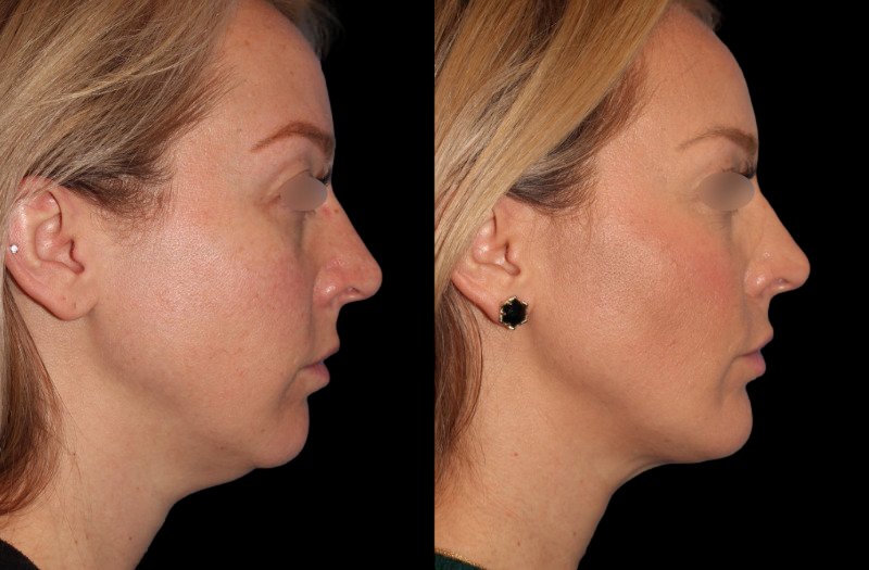 Patient 31 Combined Image