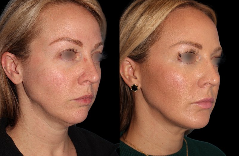 Patient 31 Combined Image