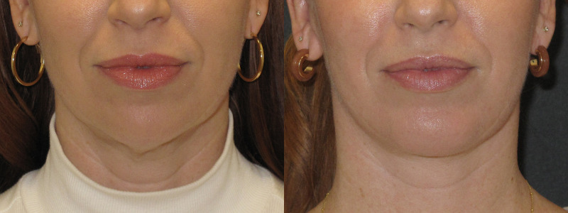 Patient 51 Combined Image