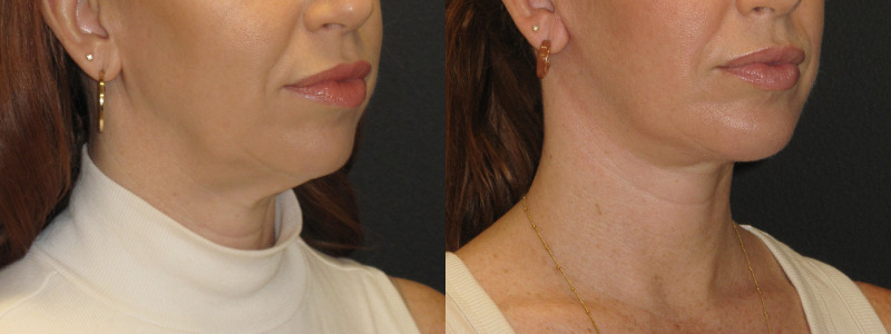 Patient 51 Combined Image