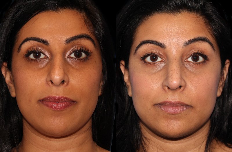 Patient 15 Combined Image