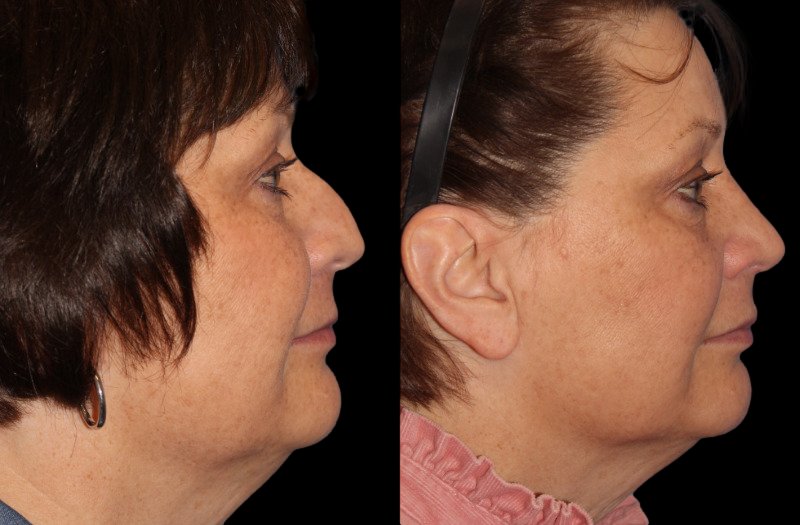 Patient 24 Combined Image