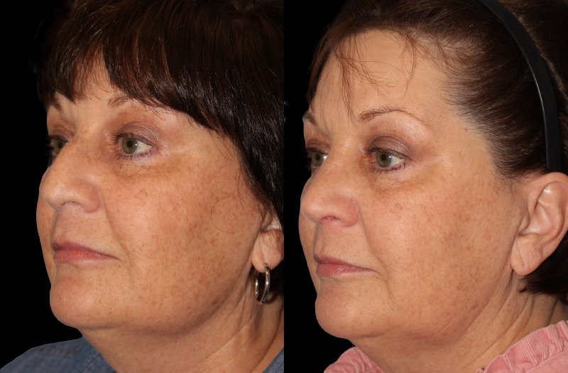 Patient 24 Combined Image