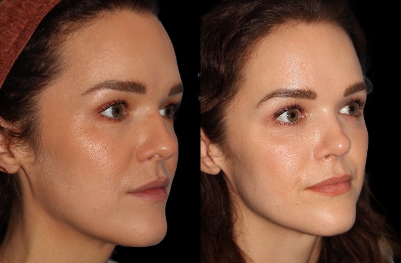 Patient 33 Combined Image