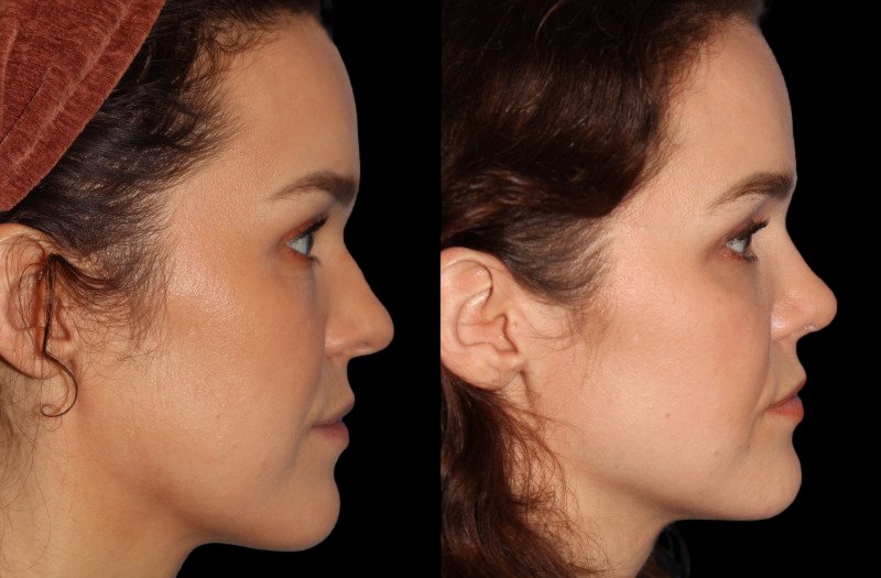 Patient 33 Combined Image