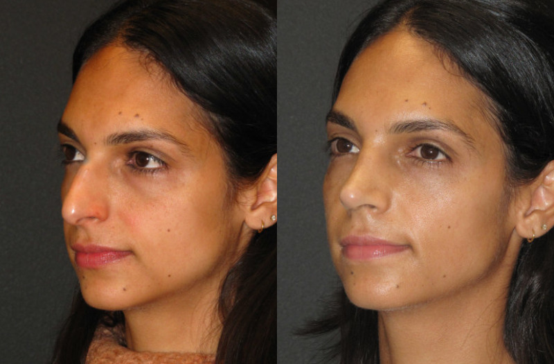 Patient 53 Combined Image