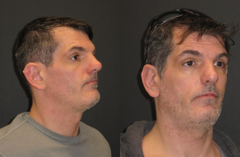 Patient 53 Combined Image