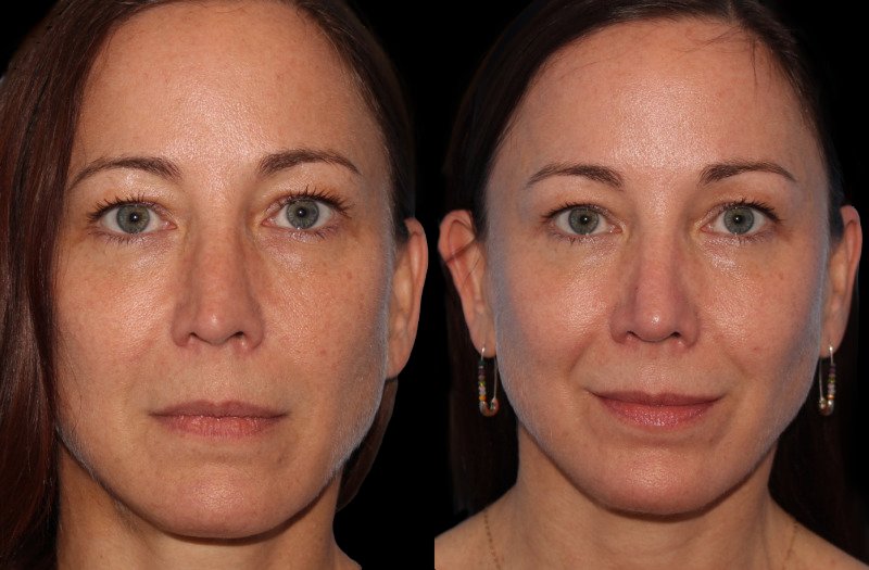 Patient 25 Combined Image