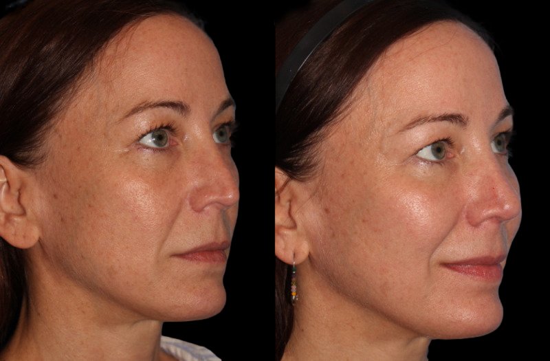 Patient 25 Combined Image