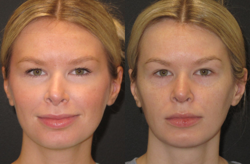 Patient 55 Combined Image