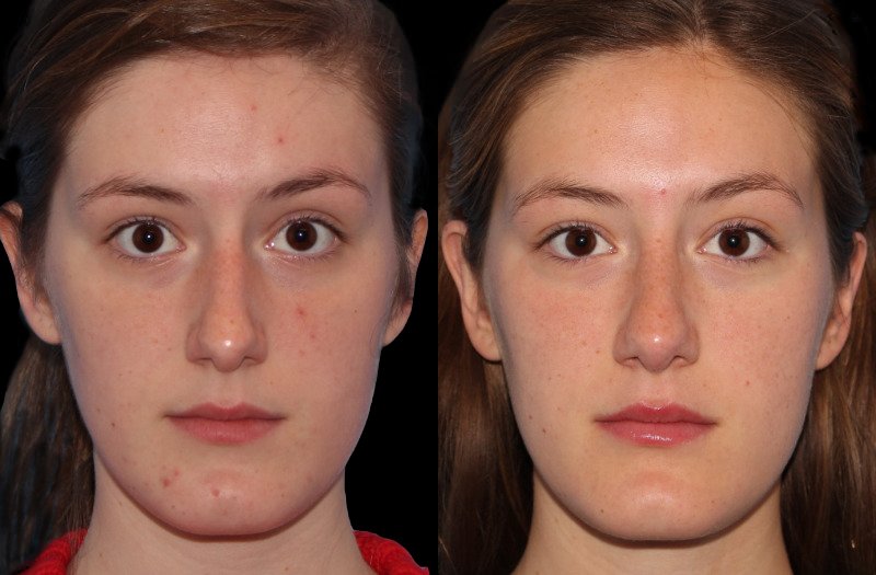 Patient 23 Combined Image