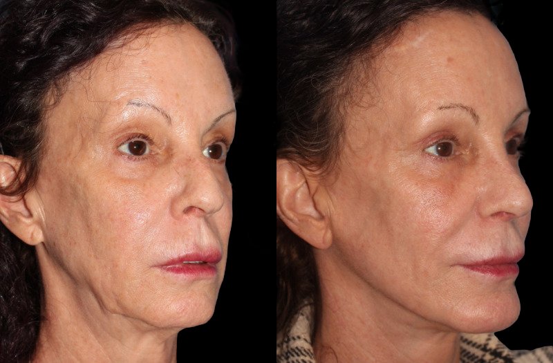 Patient 46 Combined Image