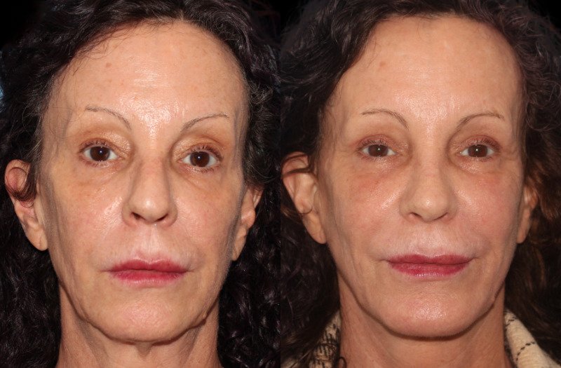 Patient 46 Combined Image