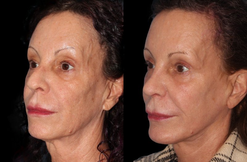 Patient 46 Combined Image