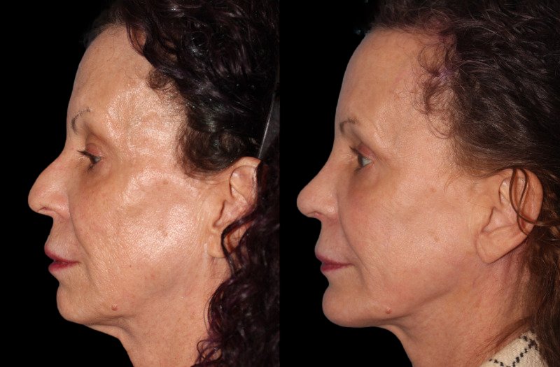 Patient 46 Combined Image