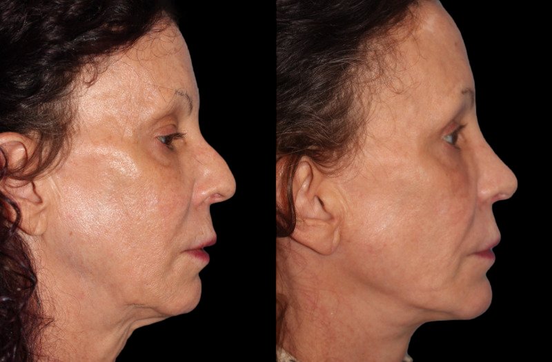 Patient 46 Combined Image