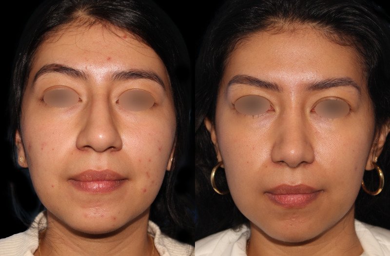 Patient 44 Combined Image