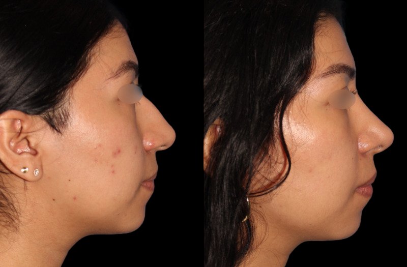 Patient 44 Combined Image