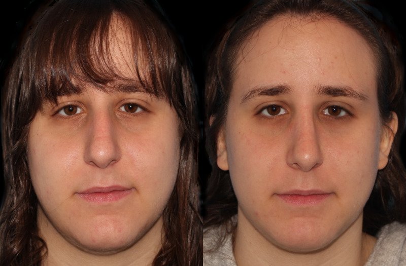 Patient 45 Combined Image
