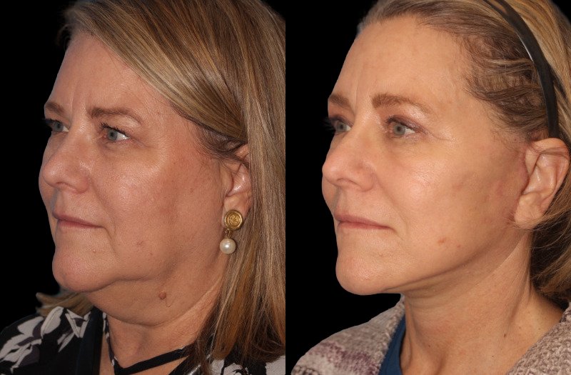 Patient 16 Combined Image