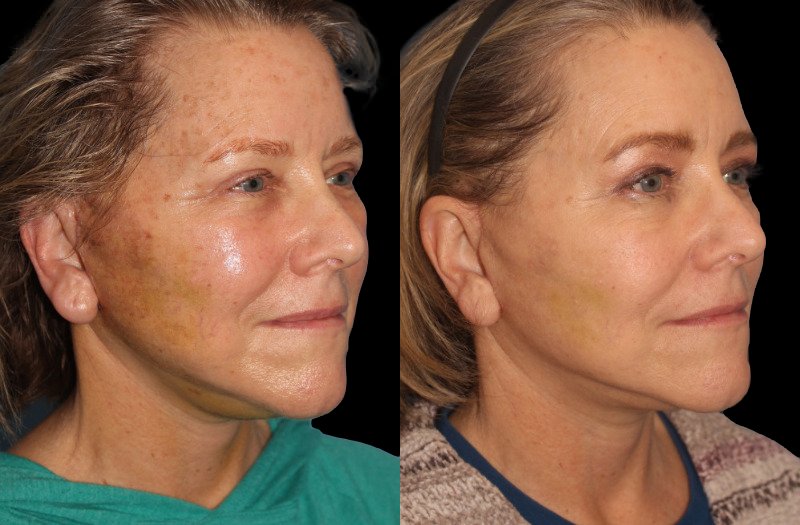 Patient 16 Combined Image