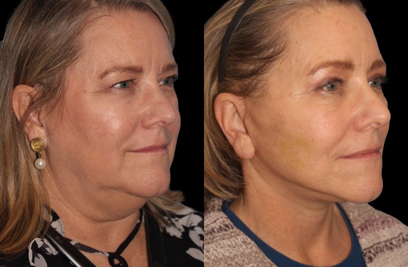 Patient 16 Combined Image