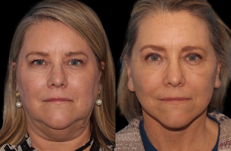 Patient 16 Combined Image