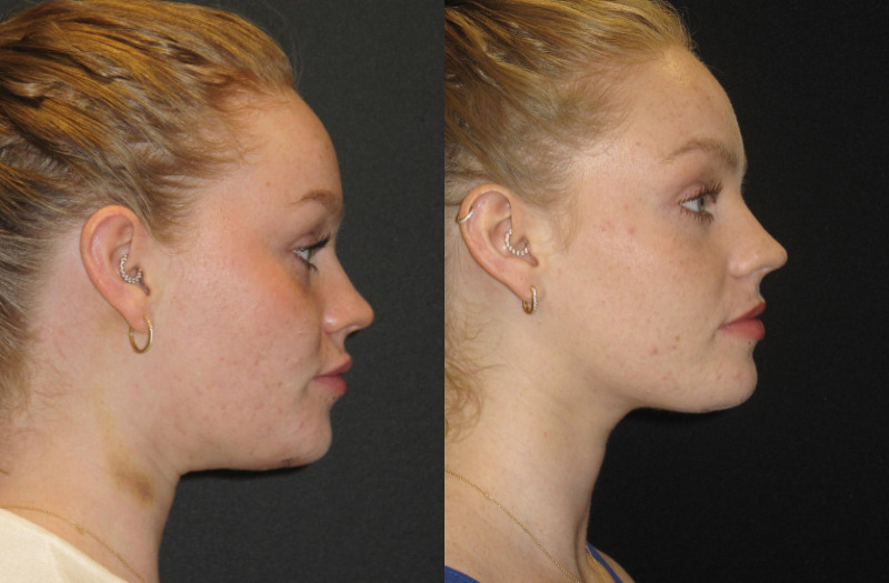 Patient 72 Combined Image