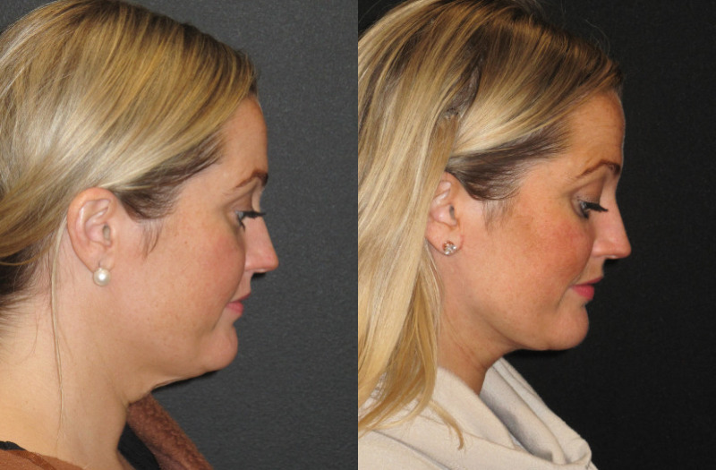 Patient 58 Combined Image